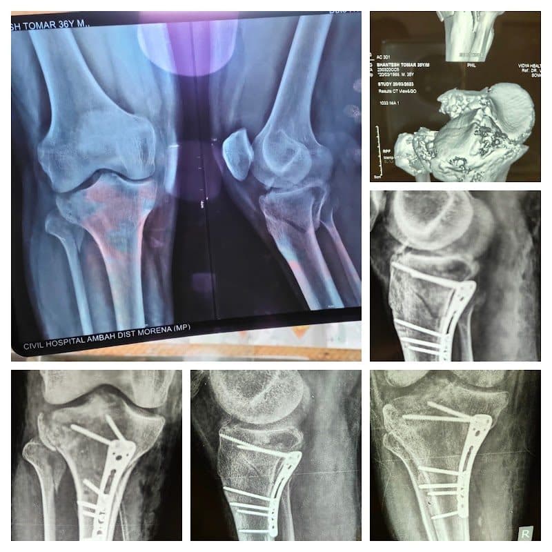 Dr. Kshitij Gupta - Orthopedic Surgeon in Gwalior | Joint & Knee Replacement | Arthroscopy | Knee Ligament & Shoulder Surgeon - Orthopedic Surgeon in Gwalior