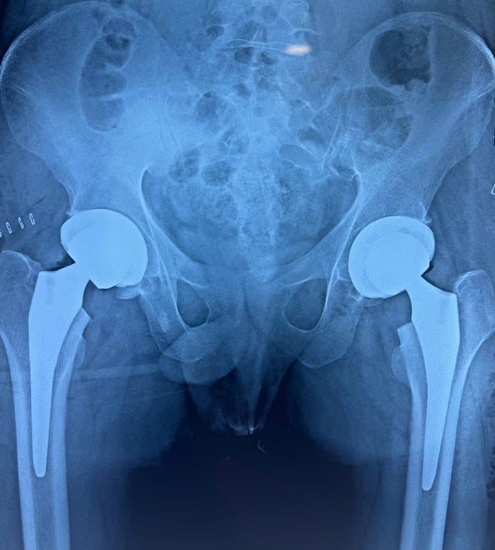 Dr M Lakshmi Naathan - Specialist in Joint Replacement and Regenerative Medicine - Orthopedic Surgeon in Chennai