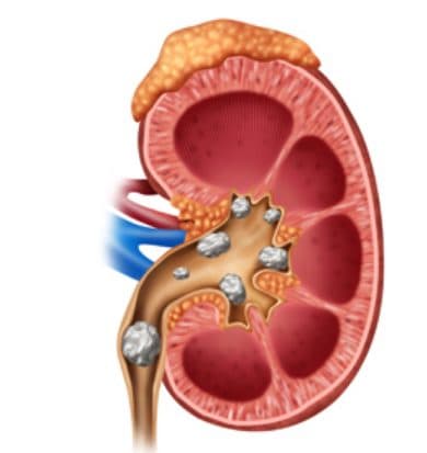 Dr. Sachin Gupta Dr. Sachin Gupta - Nephrologist in Navi Mumbai