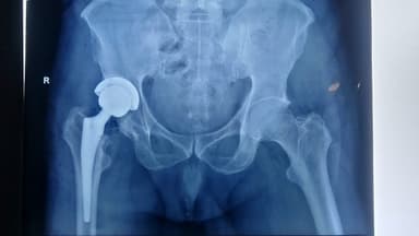 Dr. Arun Kannan | Best Orthopedic Surgeon - Robotic Knee Replacement and Hip Replacement Chennai Apollo Dr. Arun Kannan | Best Orthopedic Surgeon - Robotic Knee Replacement and Hip Replacement Chennai Apollo