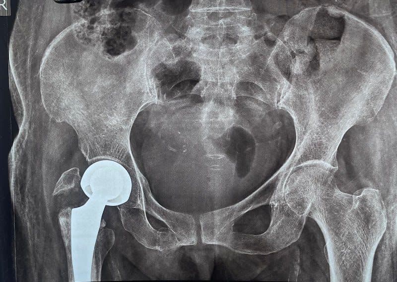 Dr Sayantan Saha l THE ADVANCED JOINT REPLACEMENT & ORTHOPAEDIC HUB l (MCh , FRCS England) Dr Sayantan Saha l THE ADVANCED JOINT REPLACEMENT & ORTHOPAEDIC HUB l (MCh , FRCS England) - Orthopedic Surgeon in Agartala