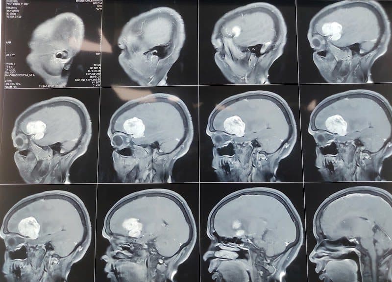 Dr. Muzammil Ambekar | Minimally Invasive Endoscopic Neurosurgeon Dr. Muzammil Ambekar | Minimally Invasive Endoscopic Neurosurgeon - Neurologist in Pune