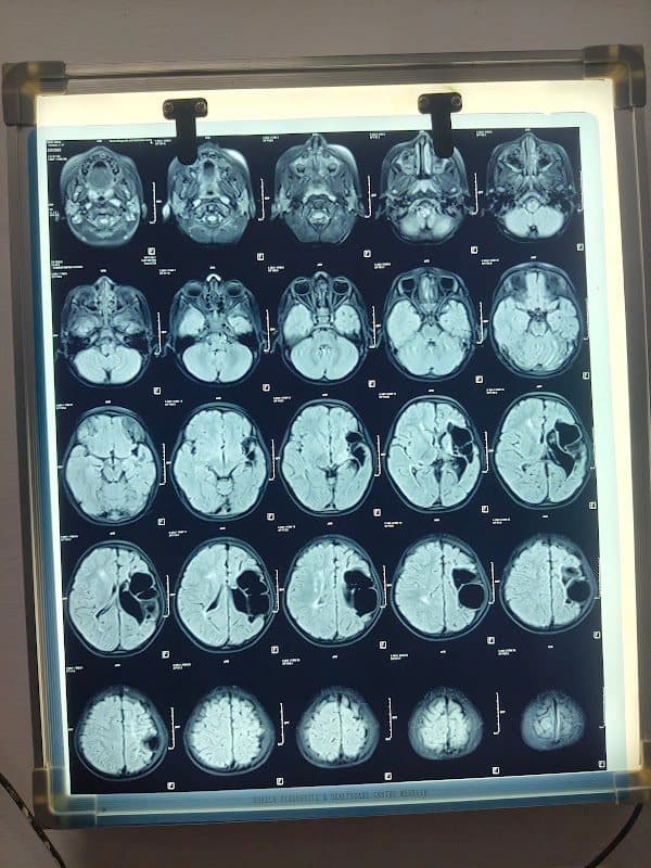 BMC Hospital - Neurosurgeon in Moradabad | Spine Surgery | Brain & Spine Tumor | Epilepsy | Paralysis | Migraine |Head Injury BMC Hospital - Neurosurgeon in Moradabad | Spine Surgery | Brain & Spine Tumor | Epilepsy | Paralysis | Migraine |Head Injury
