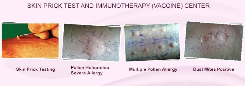Dr Rajesh K Shah,Best Allergy Doctor in Ahmedabad,#1 Girls Skin Allergy Doctor,Child Skin Specialist Dr Rajesh K Shah,Best Allergy Doctor in Ahmedabad,#1 Girls Skin Allergy Doctor,Child Skin Specialist - Rheumatologist & Immunologist in Ahmedabad