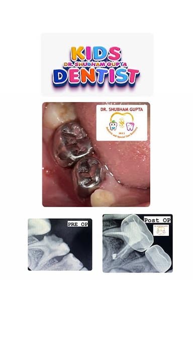 Dr Shubham Gupta (Kids Dentist) Dr Shubham Gupta (Kids Dentist)