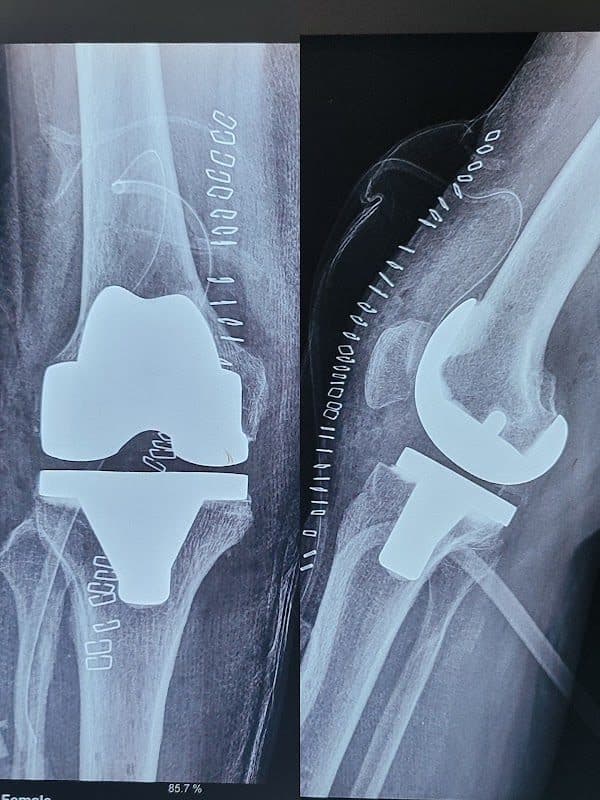 Dr. Suraj Singh Dr. Suraj Singh - Orthopedic Surgeon in Thane