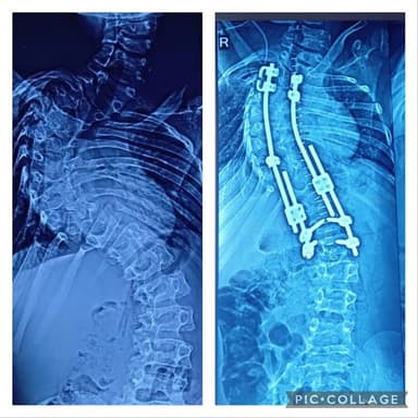 Dr Hriday Acharya - Spine surgeon & Scoliosis surgeon Dr Hriday Acharya - Spine surgeon & Scoliosis surgeon