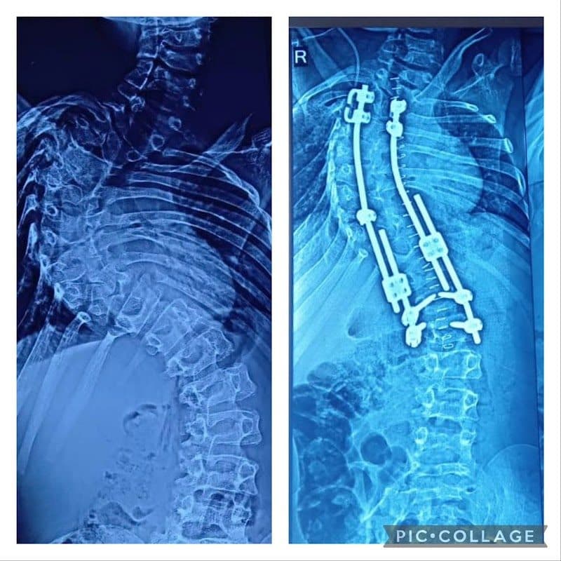 Dr Hriday Acharya - Spine surgeon & Scoliosis surgeon Dr Hriday Acharya - Spine surgeon & Scoliosis surgeon - Spine Surgeon in Ahmedabad