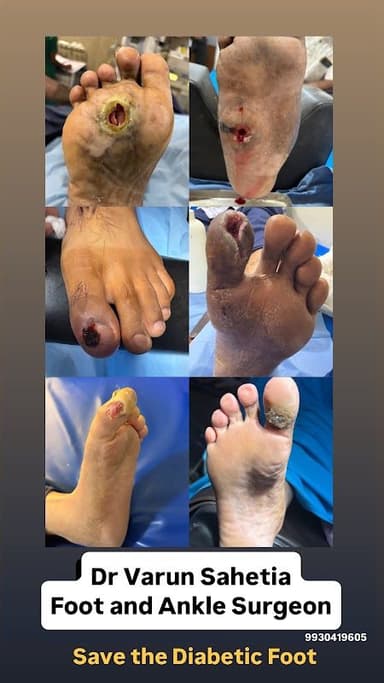 Dr Varun Sahetia - Foot and Ankle Orthopedic Surgeon in Surat | Diabetic Foot Surgeon in Surat Dr Varun Sahetia - Foot and Ankle Orthopedic Surgeon in Surat | Diabetic Foot Surgeon in Surat