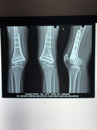 Dr. Siddharth Kumar - Arthroscopy | Joint Replacement | Best Orthopedic Surgeon in Bilaspur Dr. Siddharth Kumar - Arthroscopy | Joint Replacement | Best Orthopedic Surgeon in Bilaspur